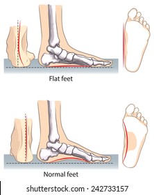 Flat and normal feet.