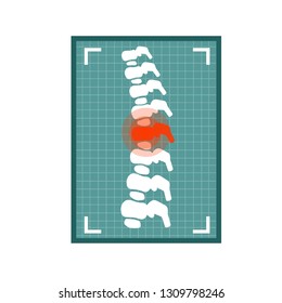 Flat Spine x-ray. Medical care. Element of doctor's office in hospital. White bones on a blue photo background. Trauma to the intervertebral disc. red dot of the pain spot. Cartoon illustration
