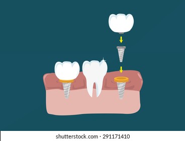 Flat Style Teeth surgical component implant to connect to the jaw. Editable Clip art. 