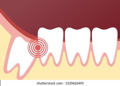 Flat toothache and dental problems concept with impacted wisdom tooth pushing healthy teeth. Vector illustration