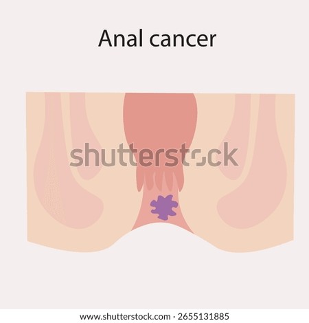 Flat vector of anal cancer highlighting symptoms like bleeding, pain, itching; includes icons of similar diseases like hemorrhoids and fissures. icon purple