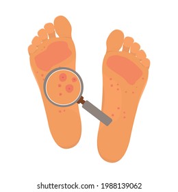 Flat vector cartoon illustration of feet atopic skin and magnifier. Red atopic skin, rashes. White background.