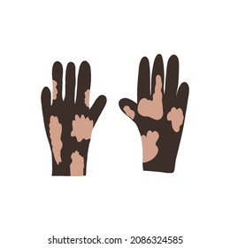 Flat vector cartoon illustration of hands with vitiligo. World vitiligo day. Skin diseases, pigmentation disorders.