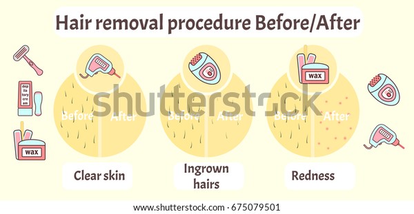 Flat Vector Hair Removal Aftereffects Infographics Stock Vector ...