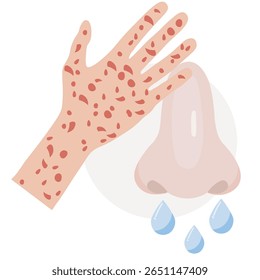 Ilustração de vetor plano de alergias mostrando sintomas como corrimento nasal, erupção cutânea pruriginosa, espirros. Inclui condições semelhantes como febre do feno, eczema e asma, design plano
