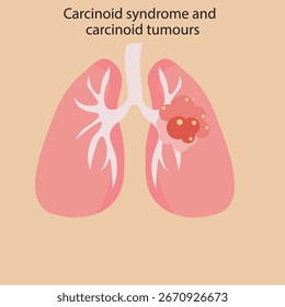Ilustración vectorial plana del síndrome carcinoide y los tumores carcinoides, que muestran síntomas clave como rubor, diarrea, sibilancias y enfermedades similares como el SII y la enfermedad de Crohn. pulmones Vector