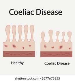 Ilustración vectorial plana de la enfermedad celíaca icónica que muestra síntomas clave como distensión abdominal, diarrea, fatiga y destaca afecciones relacionadas como el SII y la enfermedad de Crohn.
