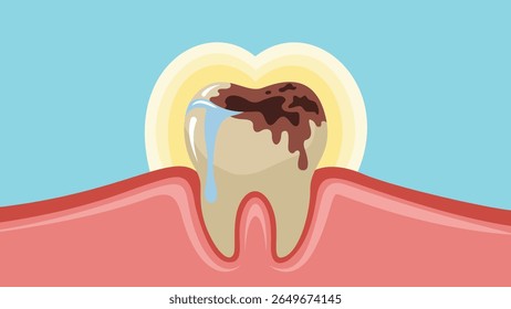 A flat vector illustration depicting a severely decayed tooth with a bright red and inflamed gum line. The tooth itself is a mottled brown with dark cavities clearly visible, showcasing a rough