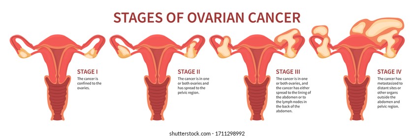 Flat vector illustration of ovarian cancer four stages mentioning ovaries, pelvic region, lining of abdomen and metastases. Woman reproductive system isolated on white background inline scheme.