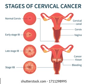 Flat vector illustration of stages of cervical cancer including normal, early, late stage IB and stage IIB. The scheme shows cervical canal, cervix, vagina, cancer tissue and bleeding.