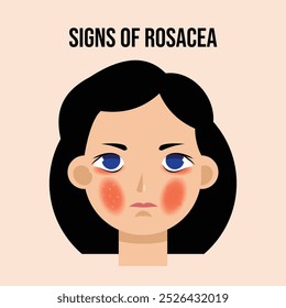 Una Ilustración vectorial plana de la cara de una mujer que destaca los signos de rosácea, incluyendo enrojecimiento, pápulas, pústulas, vasos sanguíneos visibles y problemas oculares. Ideal para el cuidado de la piel y la conciencia médica visuales