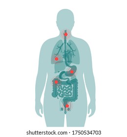 Flat vector isolated illustration of pain and inflammation in obese male body. Stomach, liver, intestine, bladder, and other internal organs icon. Medical information poster or banner