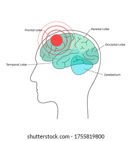 Vector plano ilustrativo aislado del dolor, la inflamación o el tumor en la anatomía cerebral masculina adulta humana. Lóbulo occipital, frontal, parietal y temporal. Infografías médicas para afiches.