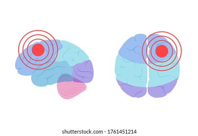 Flat Vector Isolated Illustration Of Pain, Inflammation Or Tumor In Of Human Brain Anatomy. Occipital, Frontal, Parietal And Temporal Lobe. Medical Infographics For Poster. Biological Icon.