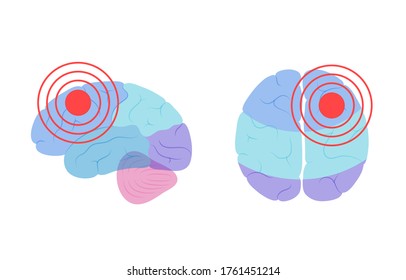 Flat vector isolated illustration of pain, inflammation or tumor in of human brain anatomy. Occipital, frontal, parietal and temporal lobe. Medical infographics for poster. Biological icon.