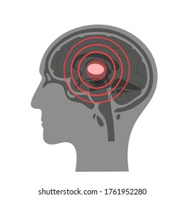 Flat vector isolated illustration of pain, inflammation or tumor in human adult male brain anatomy. Thalamus icon. Medical infographics for poster.