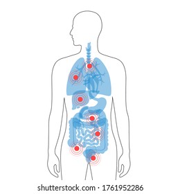 Flat vector isolated illustration of pain and inflammation in adult human body. Digestive system anatomy. Esophagus, stomach, duodenum and other internal organs icon. Medical information poster.