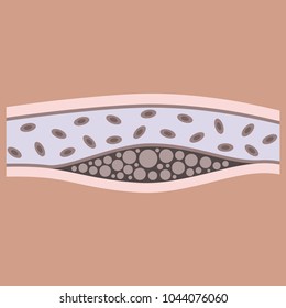 Flat vienna human atherosclerosis.the structure of a veins . the veins in the manifestation of the disease