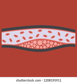 Flat vienna human atherosclerosis.the structure of a veins . the veins in the manifestation of the disease