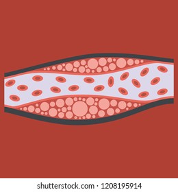 Flat vienna human atherosclerosis.the structure of a veins . the veins in the manifestation of the disease