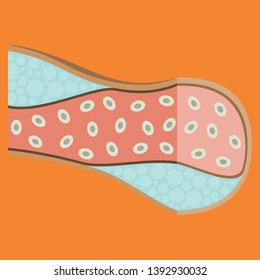 Flat vienna human atherosclerosis.the structure of a veins . the veins in the manifestation of the disease
