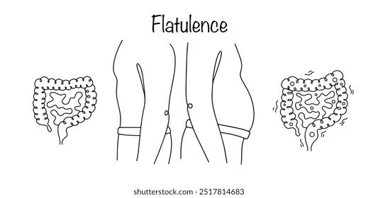 Flatulência. Inchaço doloroso devido ao acúmulo de gases em excesso nos intestinos. Um homem com um intestino saudável e um homem com inchaço. Ilustração vetorial.