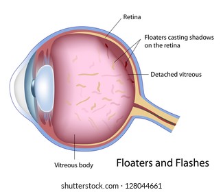 Floaters and Flashes