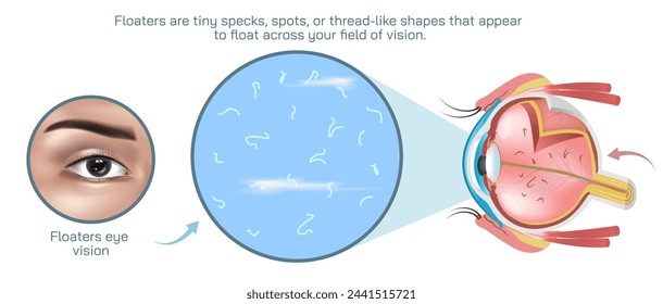 Floaters are small specks or particles that appear to float across your field of vision. They are most noticeable when you are looking at a plain background. eye syndrome and diseases vector.