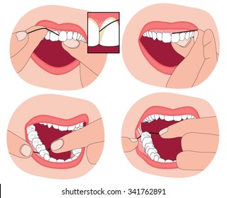 Flossing teeth, showing the floss material between the teeth and into the surrounding gum.