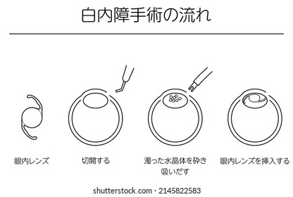 Flow of cataract surgery, illustrated illustration (line drawing) - Translation: flow of cataract surgery, intraocular lens, making incision, sucking out cloudy lens, inserting intraocular lens