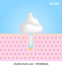 foam cream moose and lotion apply on acne skin and take it out . vector graphic