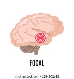 Focal Epilepsy Icon Isolated On White Background. Medical Illustration. Vector Illustration.