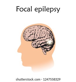 Focal Epilepsy. Vector Medical Illustration. White Background, Silhouette Of Man, Anatomy Flat Image Of Brain, Electrical Discharge.