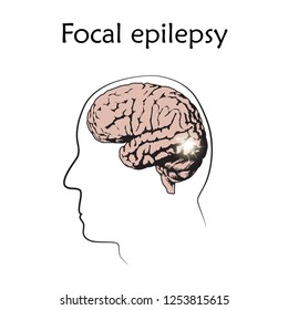 Focal Epilepsy. Vector Medical Illustration. White Background, Line Silhouette Of Man, Anatomy Flat Image Of Brain, Electrical Discharge.