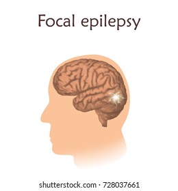 Focal Epilepsy. Vector Medical Illustration. White Background, Silhouette Of Man, Anatomy Image Of Brain, Electrical Discharge.