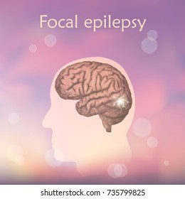 Focal Epilepsy. Vector Medical Illustration. Blurred Pink Background, Silhouette Of Man, Anatomy Image Of Brain, Electrical Discharge.