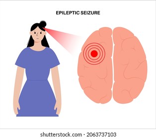 Focal Or Partial Seizure Concept. Woman Patient. Epilepsy, Abnormal Brain Activity. Pain, Spasm, Migraine Or Stress In Human Head. CNS Disorder. Mental Health Clinic. Medical Research Flat Vector