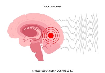 Focal, partial seizure. Epilepsy disease concept. Abnormal brain activity. Pain or spasm in human head. Central nervous system disorder. Mental health clinic. Medical research flat vector illustration
