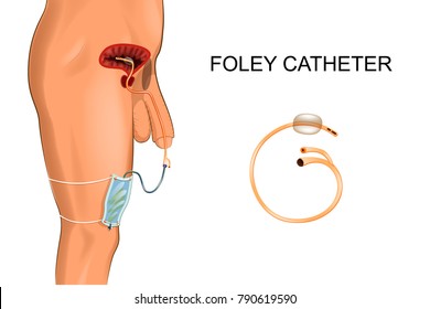 Foley Catheter. A Bag To Collect Urine