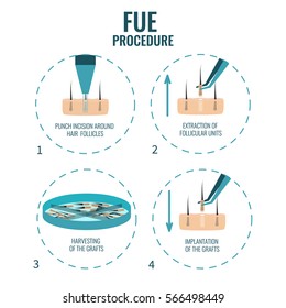 Follicular unit extraction procedure stages.  FUE hair loss treatment steps. Alopecia infographic medical design template for transplantation clinics and diagnostic centers. Vector illustration.