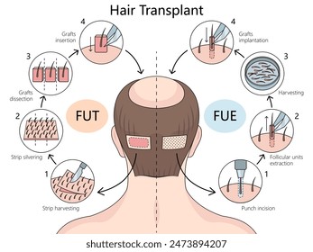 Follicular Unit Transplantation (FUT) and Follicular Unit Extraction (FUE) hair transplant techniques diagram hand drawn schematic vector illustration. Medical science educational illustration