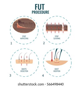 Follicular unit transplantation procedure stages. FUT hair loss treatment steps. Alopecia infographic medical design template. Clinics and diagnostic centers concept design. Vector illustration.