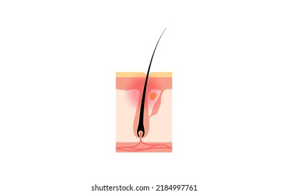 Folliculitis, inflamed skin around the hair follicles deep in the pores