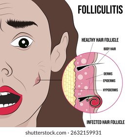 Foliculite, inflamação dos folículos pilosos.