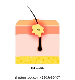 Folliculitis medical poster. Inflamed follicles with bacteria or infection. Pimple with pus in hair follicle. Itchy, sore and painful areas. Skin layers diagram, epidermis, dermis vector illustration svg
