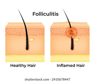 Diagrama de iluminación del vector de diseño de la ciencia de la foliculitis