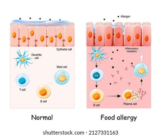 Food Allergy Is An Abnormal Immune Response To Food. Cell Of Normal Epithelium And Food Allergy. Development Of An Allergic Reaction From Allergens Penetration To Inflammatory Mediators Synthesis