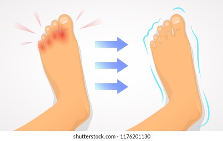 A foot affected by a fungus and a healthy foot. Result of treatment of fungus, healthсare