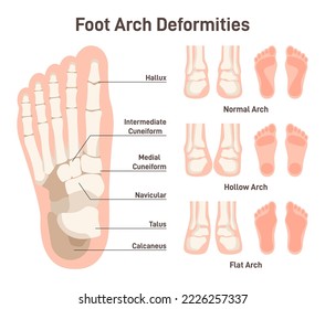 Foot anatomy scheme. Hollow and flat arch deformities. Diagram of normal and deformed bones of the lower extremities. Orthopaedic disease. Flat vector illustration.