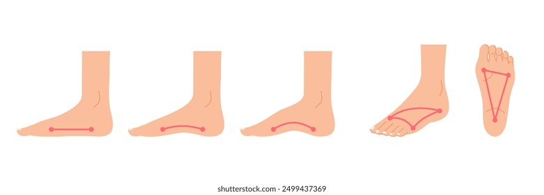 Foot arch: illustration set of the instep, sole and side of the foot (normal and collapsed arch)